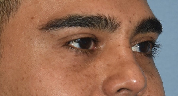 Eyelid Lift Before & After Gallery - Patient 412161 - Image 4