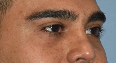 Eyelid Lift Before & After Gallery - Patient 412161 - Image 4