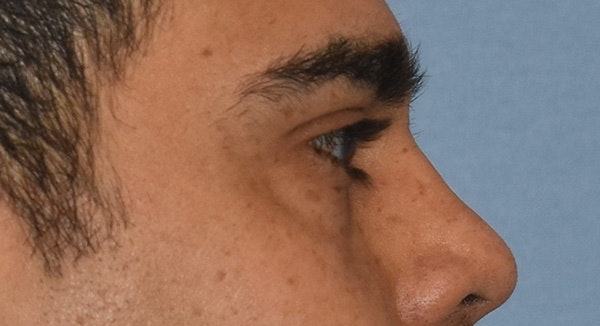 Eyelid Lift Before & After Gallery - Patient 412161 - Image 5