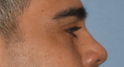 Eyelid Lift Before & After Gallery - Patient 412161 - Image 6