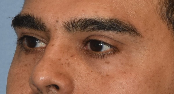 Eyelid Lift Before & After Gallery - Patient 412161 - Image 7