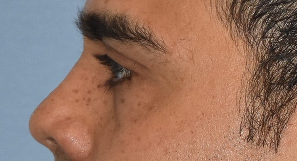 Eyelid Lift Before & After Gallery - Patient 412161 - Image 9