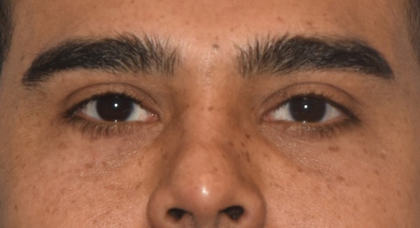 Eyelid Lift Before & After Gallery - Patient 412161 - Image 2
