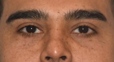 Eyelid Lift Before & After Gallery - Patient 412161 - Image 2