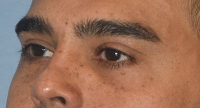 Eyelid Lift Before & After Gallery - Patient 412161 - Image 8