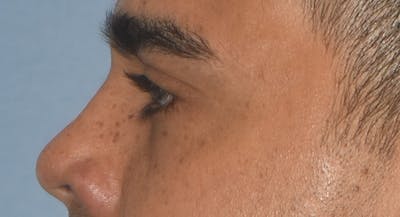 Eyelid Lift Before & After Gallery - Patient 412161 - Image 10