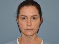Facelift Before & After Gallery - Patient 379132 - Image 1