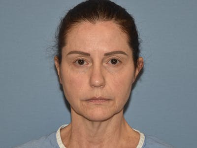 Facelift Before & After Gallery - Patient 379132 - Image 1