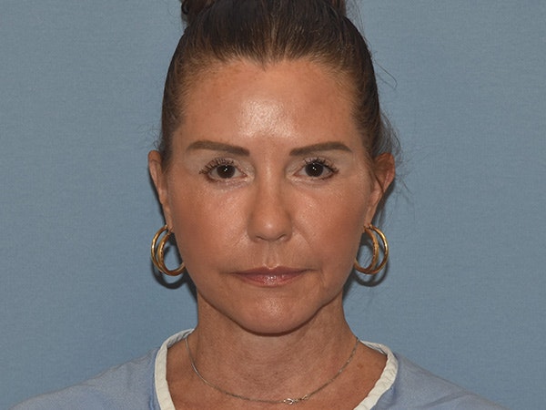 Facelift Before & After Gallery - Patient 379132 - Image 2