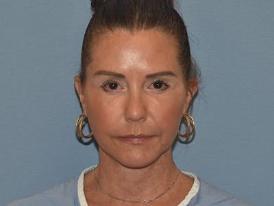 Facelift Before & After Gallery - Patient 379132 - Image 2
