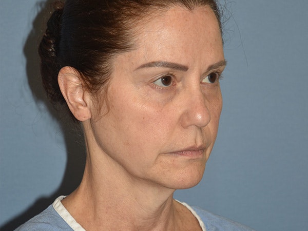 Facelift Before & After Gallery - Patient 379132 - Image 3