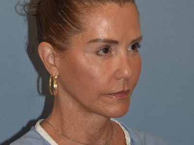 Facelift Before & After Gallery - Patient 379132 - Image 4