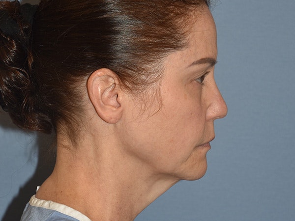 Facelift Before & After Gallery - Patient 379132 - Image 5