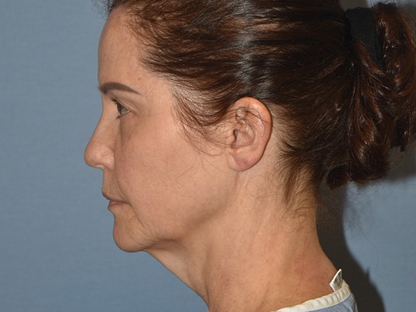 Facelift Before & After Gallery - Patient 379132 - Image 9
