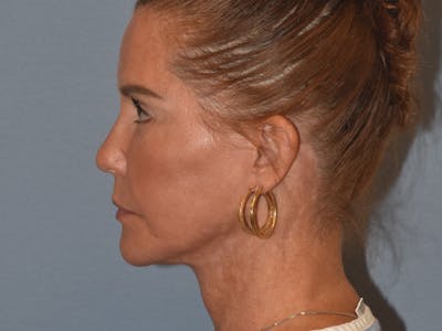 Facelift Before & After Gallery - Patient 379132 - Image 10