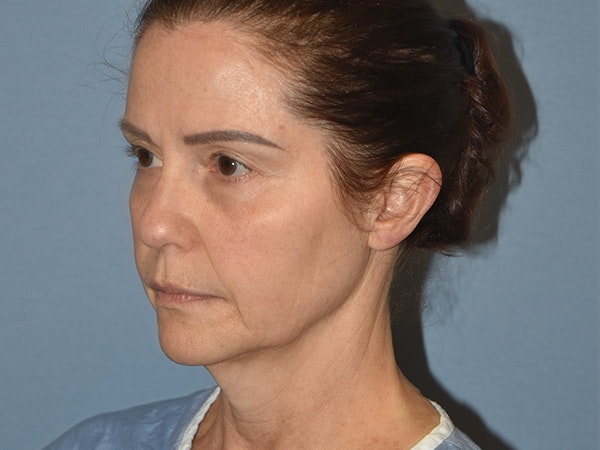 Facelift Before & After Gallery - Patient 379132 - Image 7