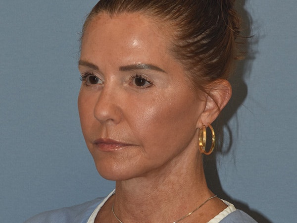 Facelift Before & After Gallery - Patient 379132 - Image 8