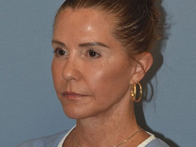 Facelift Before & After Gallery - Patient 379132 - Image 8