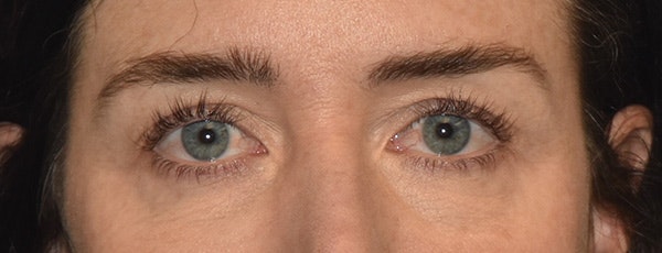 Eyelid Lift Before & After Gallery - Patient 835091 - Image 1