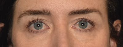 Eyelid Lift Before & After Gallery - Patient 835091 - Image 1