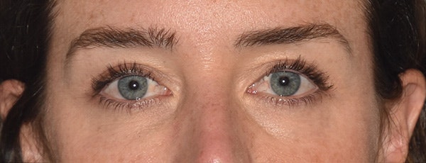 Eyelid Lift Before & After Gallery - Patient 835091 - Image 2