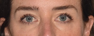 Eyelid Lift Before & After Gallery - Patient 835091 - Image 2