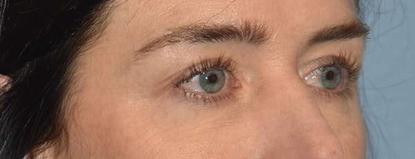 Eyelid Lift Before & After Gallery - Patient 835091 - Image 3