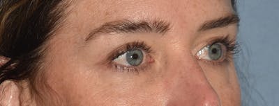 Eyelid Lift Before & After Gallery - Patient 835091 - Image 4