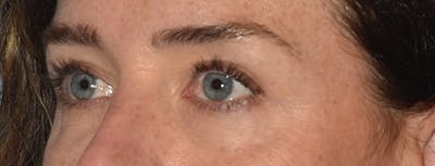 Eyelid Lift Before & After Gallery - Patient 835091 - Image 8