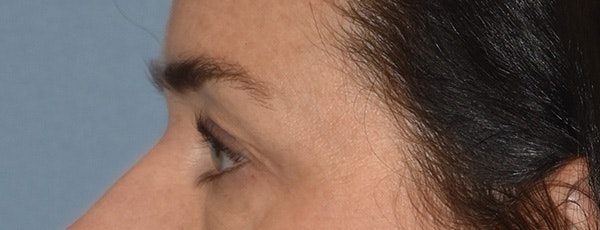 Eyelid Lift Before & After Gallery - Patient 835091 - Image 9