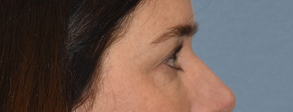 Eyelid Lift Before & After Gallery - Patient 835091 - Image 5