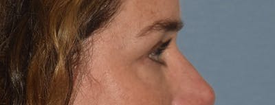 Eyelid Lift Before & After Gallery - Patient 835091 - Image 6