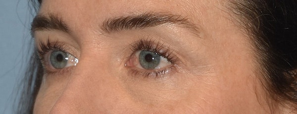 Eyelid Lift Before & After Gallery - Patient 835091 - Image 7