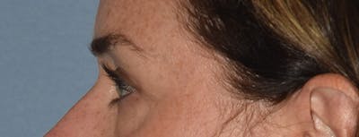 Eyelid Lift Before & After Gallery - Patient 835091 - Image 10