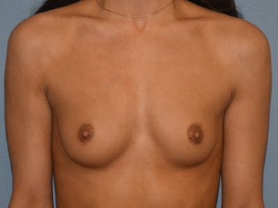 Breast Augmentation Before & After Gallery - Patient 112637 - Image 1