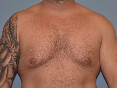 Gynecomastia Before & After Gallery - Patient 404054 - Image 1