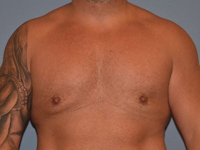 Gynecomastia Before & After Gallery - Patient 404054 - Image 2