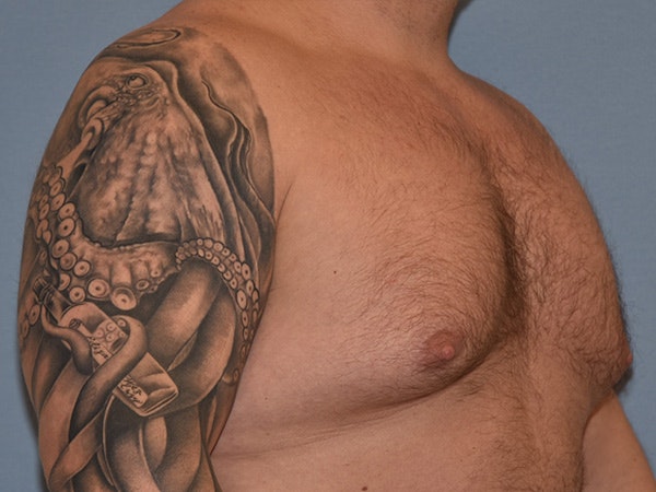 Gynecomastia Before & After Gallery - Patient 404054 - Image 3