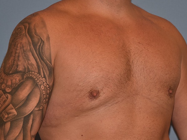 Gynecomastia Before & After Gallery - Patient 404054 - Image 4