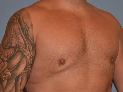 Gynecomastia Before & After Gallery - Patient 404054 - Image 4