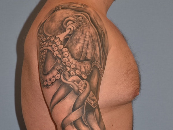 Gynecomastia Before & After Gallery - Patient 404054 - Image 5