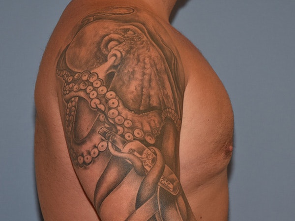 Gynecomastia Before & After Gallery - Patient 404054 - Image 6