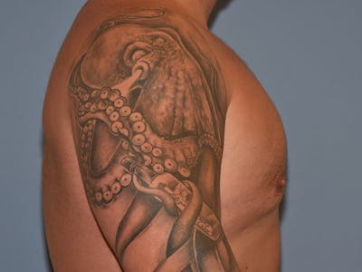 Gynecomastia Before & After Gallery - Patient 404054 - Image 6