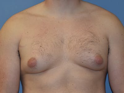 Gynecomastia Before & After Gallery - Patient 311882 - Image 1