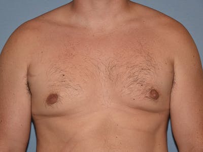 Gynecomastia Before & After Gallery - Patient 311882 - Image 2