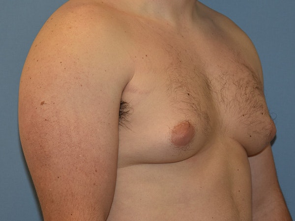 Gynecomastia Before & After Gallery - Patient 311882 - Image 3