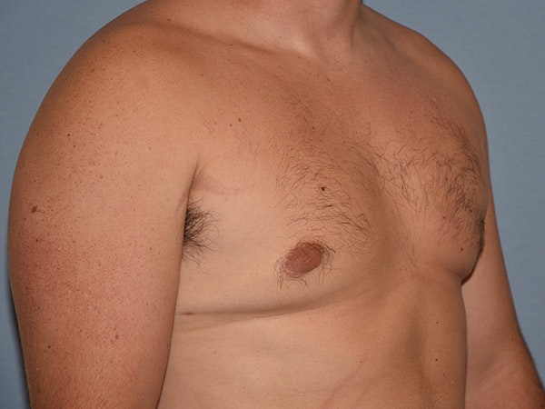 Gynecomastia Before & After Gallery - Patient 311882 - Image 4