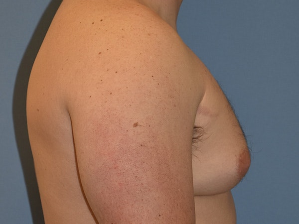 Gynecomastia Before & After Gallery - Patient 311882 - Image 5