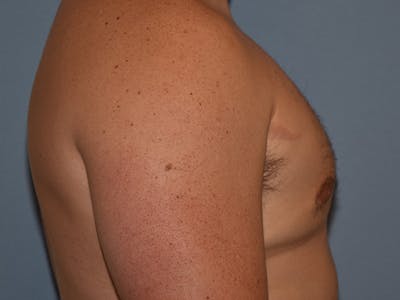 Gynecomastia Before & After Gallery - Patient 311882 - Image 6