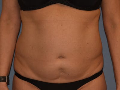 Tummy Tuck Before & After Gallery - Patient 206873 - Image 1